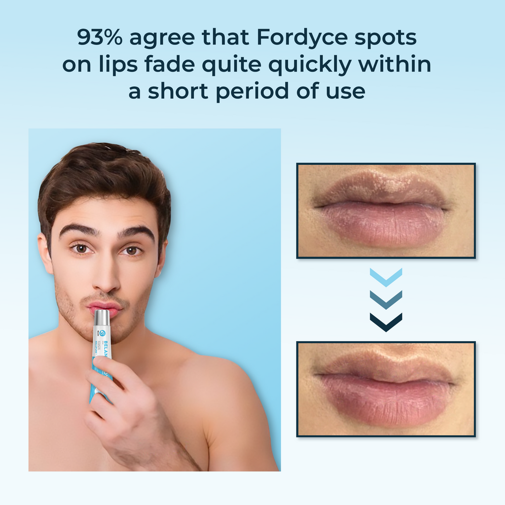 Lip Acne Cream, Fordyce Seeds - Lip Acne, Moisturizes, Improves Dry, Chapped Lips, Reduces Dark Lips